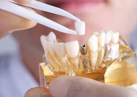 هشدارهای مهم درباره ایمپلنت دندان