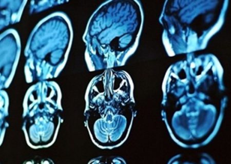 تولید محصولی جدید برای تشخیص و درمان بیماری‌های مغزی